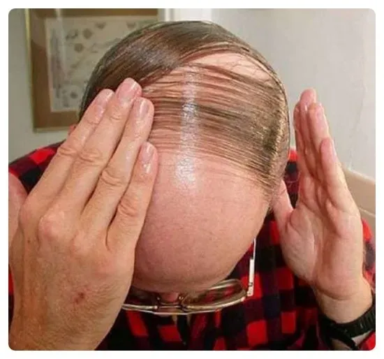 대머리를 가리는법!