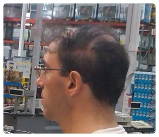 대머리를 가리는법!