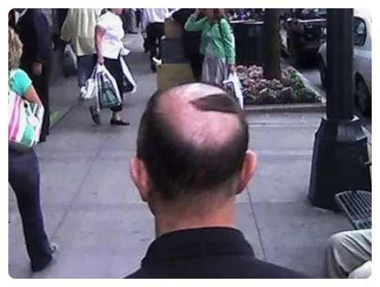 대머리를 가리는법!