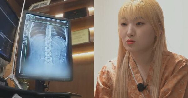 히밥의 위 상태 /사진='토요일은 밥이 좋아'