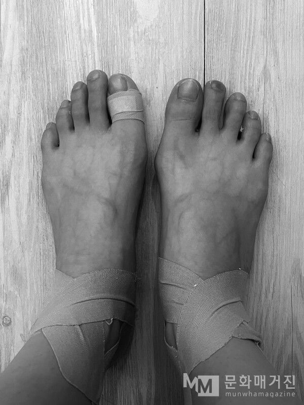 ▲ 21.2km를 완주한 벼내림의 발. 자세히 보면 오른쪽 검지 발톱에 피가 고여있다 / 사진: 벼내림 제공