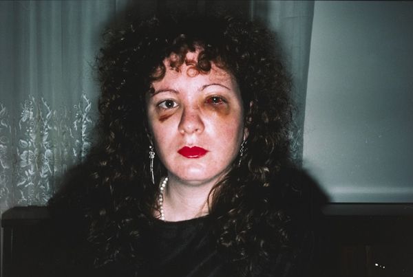 ▲ Nan Goldin, Nan One Month After Being Battered / 사진: MOCA 제공
