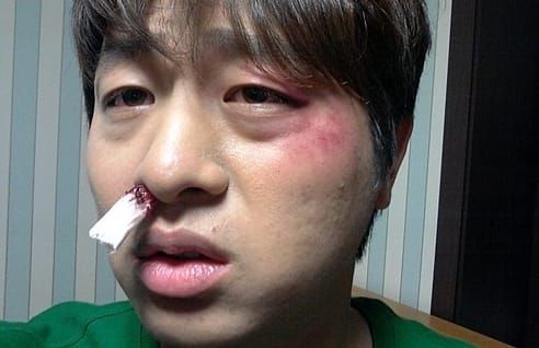 장동민에게 폭행당한 유상무 셀카 / 출처 - 온라인 커뮤니티
