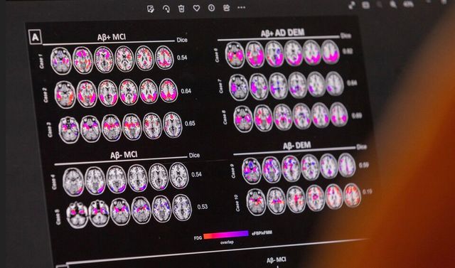스위스 제네바에 있는 대학병원(HUG) 노인병학과 기억센터에서 알츠하이머병을 앓는 환자의 자료가 보여지고 있다. /로이터 연합뉴스