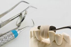 브릿지는 치아가 빠졌지만 임플란트 시술을 할 수 없을 때 하는 치료법이다. /게티이미지뱅크