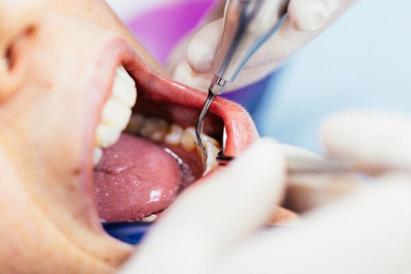 스케일링이라는 술식은 이물질을 치아와 잇몸으로부터 분리해 내는 치료이지 치아를 갈아내는 치료가 아니다. /게티이미지뱅크