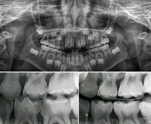 파노라마 방사선 사짐 및 치아사이의 충치를 검사하는 교익사진