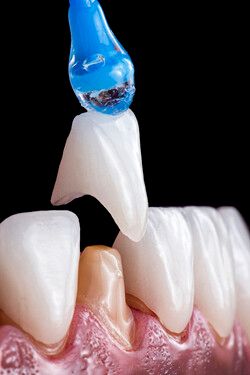 보철 /게티이미지뱅크