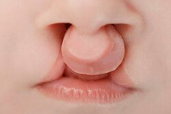 구순구개열 환자의 모습 /게티이미지뱅크