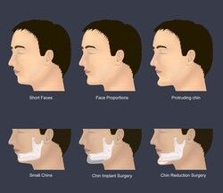 양악수술의 종류 /게티이미지뱅크