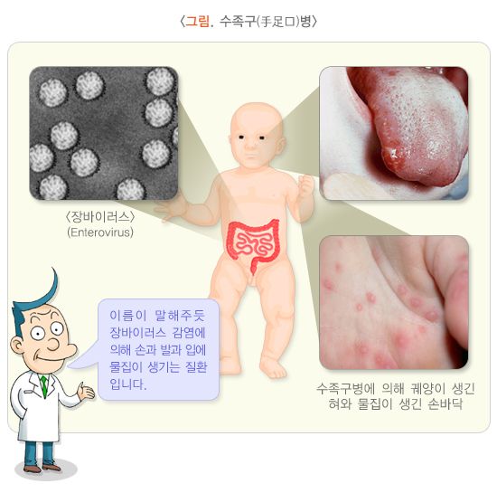 수족구병 (사진=국가건강정보포털)