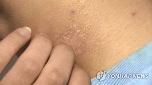 삶의질 떨어뜨리는 은백색 각질 '건선'…