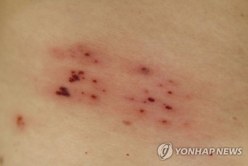 '찌르고 타는 듯' 대상포진…