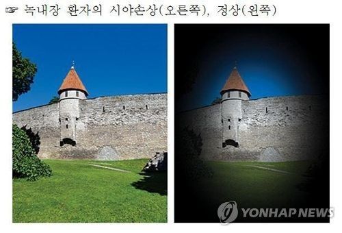 초고령사회의 그늘 '녹내장'…