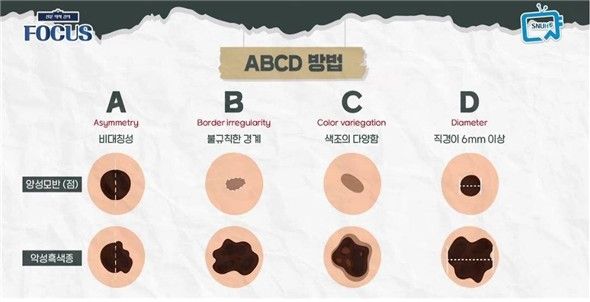 '점'인 줄 알았는데 '암'…알아두면 좋은&nbsp;피부암&nbsp;'ABCD룰'[연합뉴스]