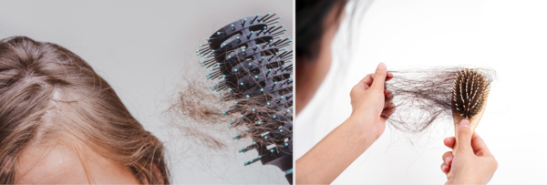 탈모 이미지 (사진 출처 : 프리픽)