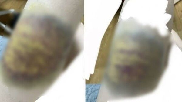 피해자가 올린 상해 사진 (사진출처 : 온라인 커뮤니티)