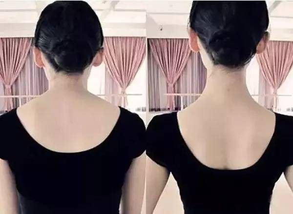 거북목의 교정으로 달라진 뒷 모습 ( 사진 = 온라인 커뮤니티 )