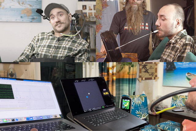 뉴럴링크의 컴퓨터 칩을 뇌에 이식한 놀랜드 아르보. (사진=뉴럴링크)