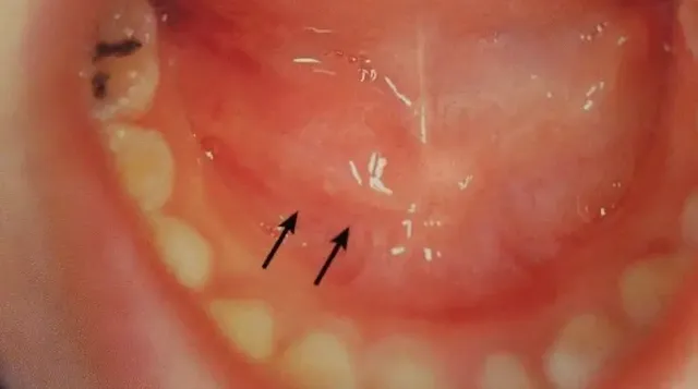 귀밑-통증-타석증