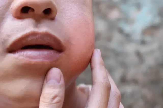 귀밑-통증-침샘염