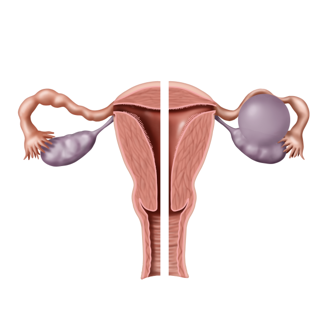 난소낭종 이미지. 연합뉴스