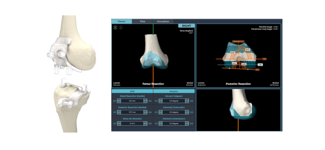 스카이브가 개발한 환자 맞춤형 인공관절 수술 도구 니비게이트가 최근 보건복지부 평가 유예 신의료기술로 선정됐다. 스카이브