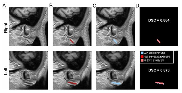 3차원 이미지를 토대로 전문가가 수동으로 직접 표시한 주름과 AI가 예측해 자동으로 표시한 영역. 분당서울대병원 제공