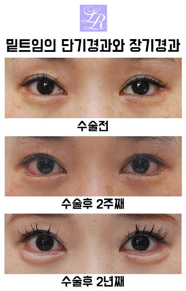 성형외과의사들도 말리는 뒷,밑트임 + 그럼에도 하는 이유 | 인스티즈