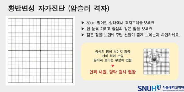 황반변성 자가진단 사진. / 서울대학교병원