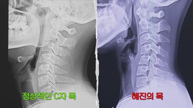 한혜진 거북목 교정 | 출처 유튜브 〈한혜진〉