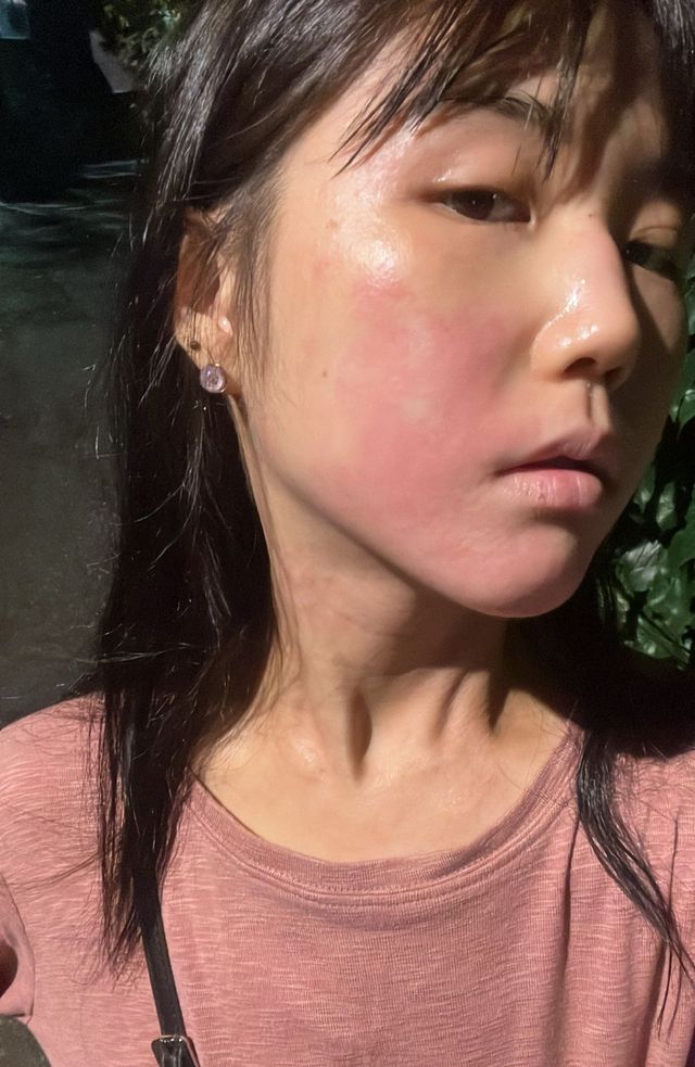 여름에는 땀과 열로 인해, 겨울에는 건조함으로 아토피 피부염 증상이 심해진다.