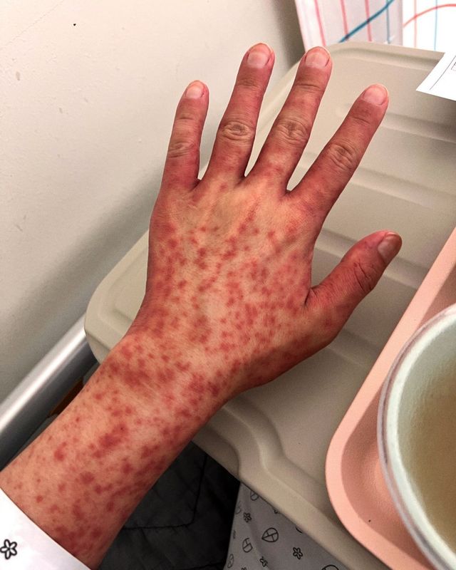 백혈병 치료 중 온몸에 붉은 반점이 나타나고 피부가 터질 듯 붓기도 했다.