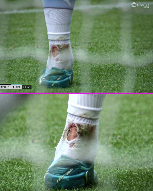 맨시티가 지난 28일(한국시간) 영국 뉴캐슬어폰타인에 있는 세인트 제임스 파크에서 열린 뉴캐슬 유나이티드와의 2024-2025시즌 프리미어리그 6라운드 원정 경기에서 1-1로 비겼다.&nbsp;홀란은 전반 37분경 한 차례 경합 이후 과정에서 통증을 느꼈다. 중계 화면에서 그의 스타킹 발목 부분이 찢어져 있었고 피가 났다.&nbsp; 홀란은 경기 종료 후 퇴근하면서 발을 절뚝거리는 모습이 포착돼 다음 달 2일 오전 4시 슬로바키아 브라티슬라바에 있는 나로드니 푸트발로비 슈타디온에서 열리는 슬로반 브라티슬라바와의 유럽축구연맹(UEFA) 챔피언스리그 리그 페이즈 2차전 원정 경기 출전 여부가 불투명하다.&nbsp;TNT스포츠