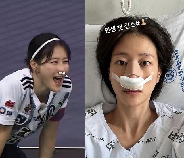 코뼈 골절 부상을 당한 이현이.