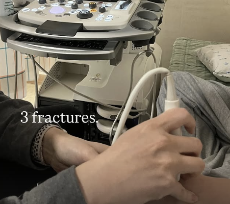 2026 밀라노·코르티나담페초 동계올림픽에서 한국 스키·스노보드 역사상 첫 금메달을 획득한 최가온(18·세화여고)이 결승전 당시 손뼈 골절상을 입은 상태로 경기를 치른 것으로 보인다. 자신의 SNS에 병원에서 손등과 손목 부위 진단을 받는 사진을 공개했다. 이 부상은 지난 13일 이탈리아 리비뇨 스노파크에서 열린 스노보드 여자 하프파이프 결승 1차 시기 도중 발생한 것일 가능성이 크다. SNS