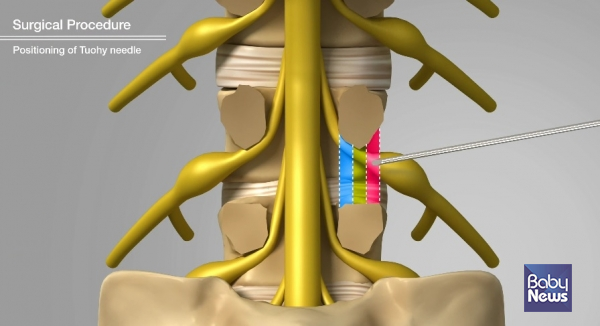 추간공을 적색(외측), 녹색(중앙), 청색(내측)으로 구분 설명하는 모식도.&nbsp;ⓒ광혜병원
