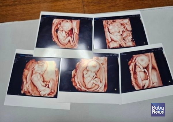 최근 다섯 쌍둥이를 자연임신해 분만에 성공한 김준영-사공혜란 부부의 오둥이 초음파 사진. ⓒ서울성모병원