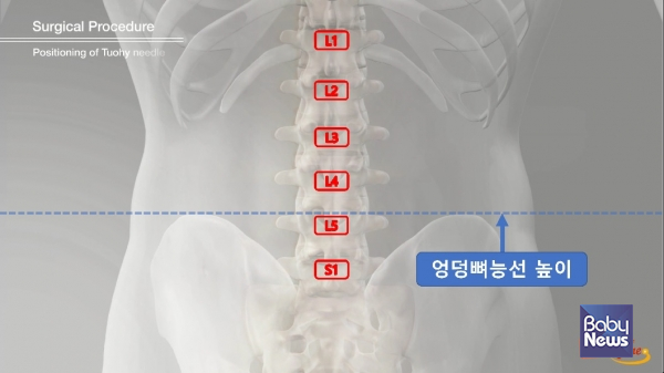 그림 : L5~S1 추간공확장술 공략시 핵심 고려사항인 엉덩뼈능선의 높이를 나타낸 모식도. ⓒ서울 광혜병원
