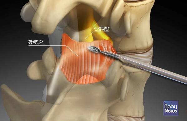 추간공 인대를 특수키트로 절제해 공간을 넓히고 있는 추간공확장술 모습. ⓒ광혜병원