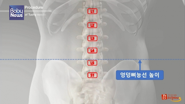 L5~S1 부위 추간공 공략시 가장 핵심인 엉덩뼈 능선의 높이를 나타낸 모식도. ⓒ광해병원