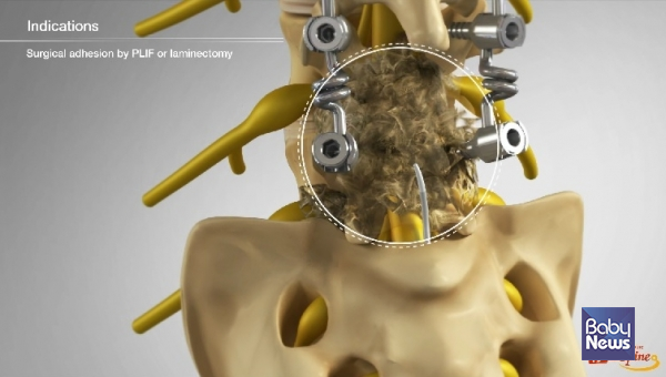 척추 수술한 마디가 수술성 유착으로 막혀 꼬리뼈접근법으로 카테터 접근이 어려운 모습. ⓒ서울 광혜병원