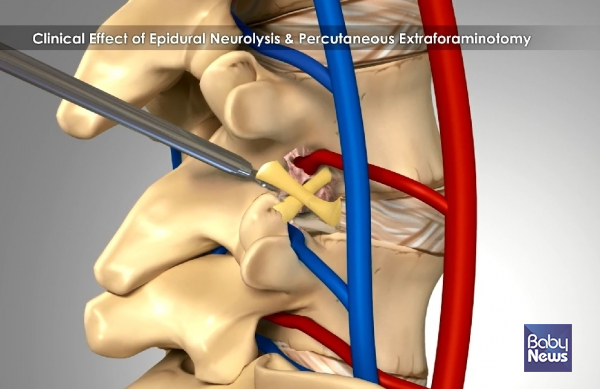 추간공확장술 특수키트를 이용하여 추간공 주변의 인대를 절제하는 모습. ⓒ서울 광혜병원