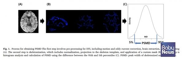 PSMD 산출 과정, 뇌 확산텐서영상(DTI)에서 주요 백질 신경섬유만 추출한 뒤, 확산도 분포의 상위 95%와 하위 5% 값의 차이를 계산해 PSMD를 산출한다. PSMD 값이 클수록 뇌 백질의 미세구조 손상이 큰 것으로 해석된다. ⓒ해운대백병원
