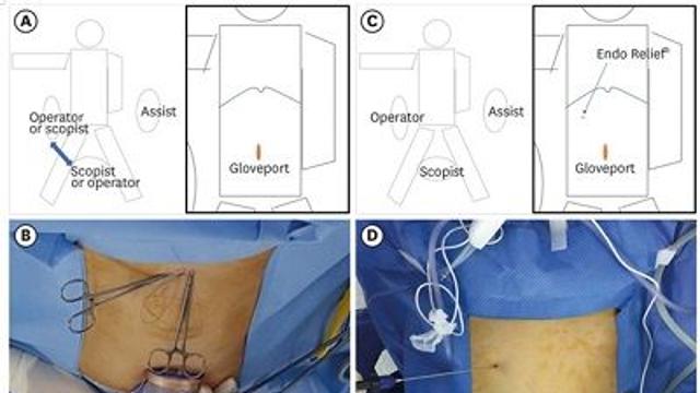 ‘Needle Grasper’ 활용, ‘단일공 복강경위절제술’ 위암 수술시간 단축 효과