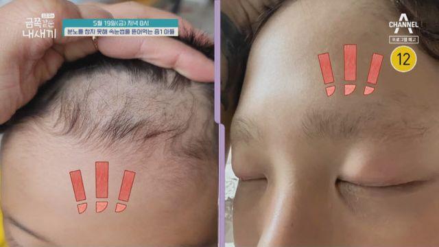 금쪽 머리카락·속눈썹 잡아 뽑는 중1…오은영 어마어마한 위기