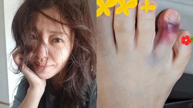 싱글맘 이지현, 아이에 온몸 던져 발가락 부상…제대로 걷지도 못해