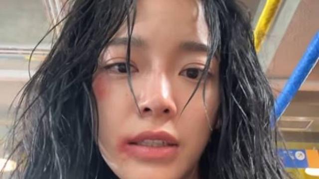 김세정, 팬들 가슴 쓸어내린 피멍 셀카…진짜인 줄