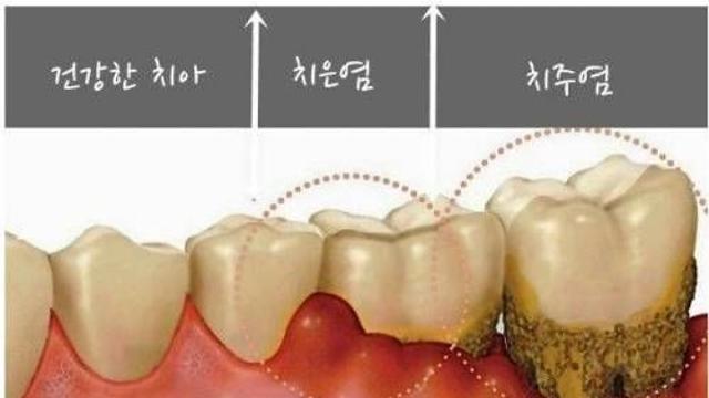 치석을 제거해야 하는 이유.jpg,,