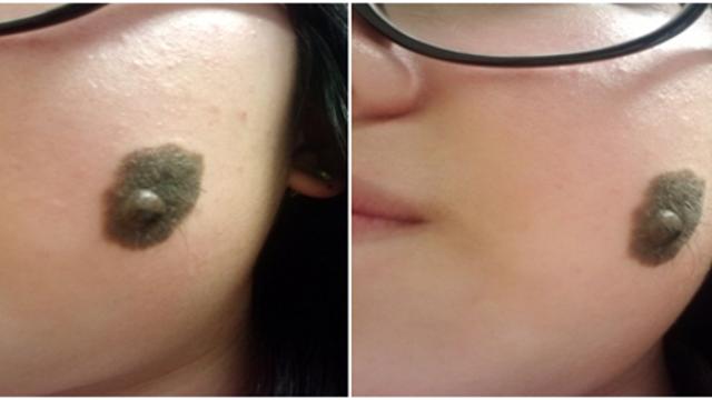 얼굴에 난 점이 고민이라는 여학생.jpg